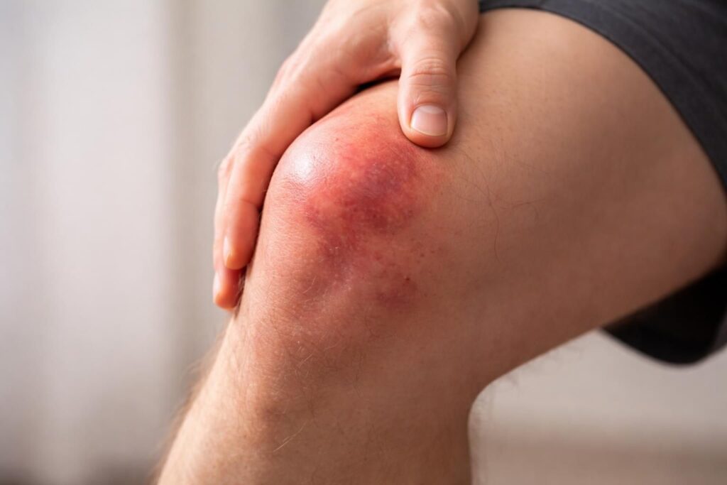 découvrez les symptômes du ligament croisé à surveiller après un traumatisme pour une prise en charge rapide et efficace.